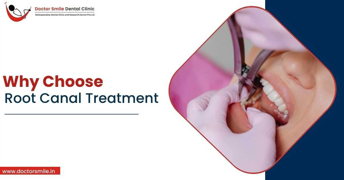 Why Choose Root Canal Treatment?