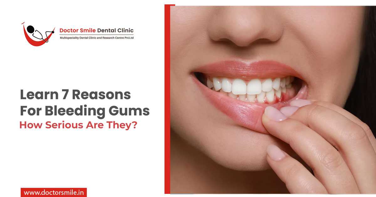 Learn 7 Reasons for Bleeding Gums: How Serious Are They?