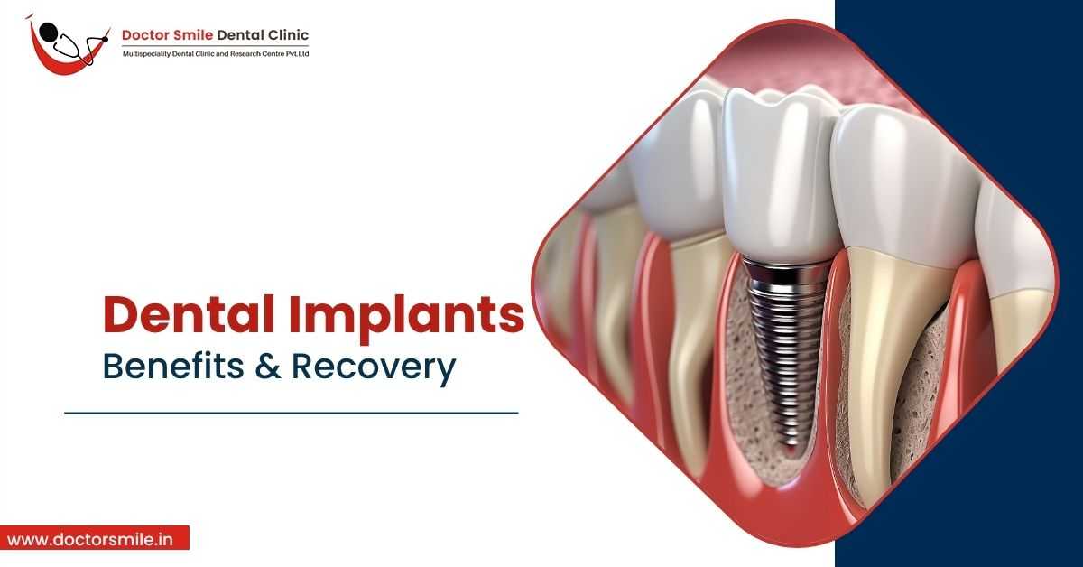 Dental Implants Benefits and Recovery