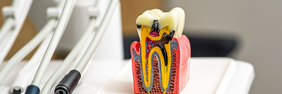 Painless Root Canal Treatment